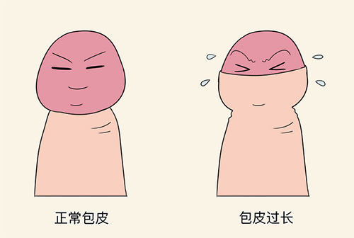 包皮过长不割有影响性功能吗