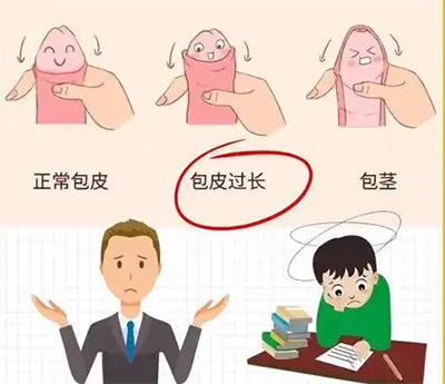 包皮过长不割有影响吗