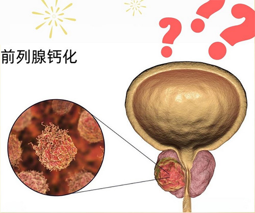 前列腺钙化有什么影响，小心这8个风险