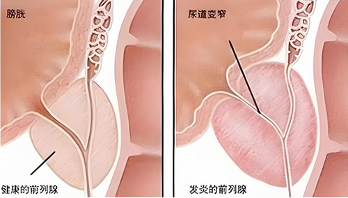 前列腺炎是怎么造成的，导致前列腺炎的5个原因