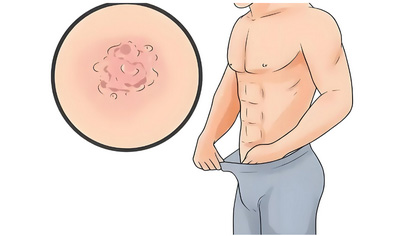 男性毛毛处长痘痘严重吗