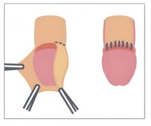 割了皮包多久恢复正常可以同房