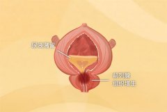 前列腺增生手术能彻底治愈吗