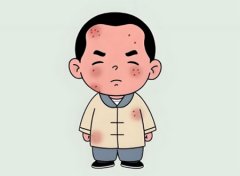 疱疹好转的四个迹象