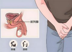 前列腺炎要禁欲多久