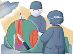 孩子包茎手术最佳年龄