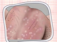 男人得了毛囊炎如何治疗好