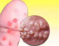 包皮上面长小水泡是什么原因