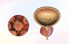 前列腺钙化是怎么回事，需要治疗吗