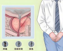 前列腺炎有哪些症状表现