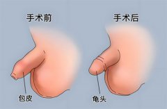 小孩包皮过长手术最佳年龄