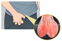 男性阴囊骚痒是被传染的吗