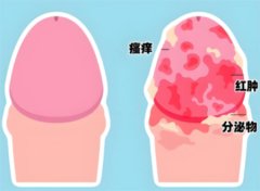 包皮会感染性病吗