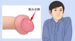 包皮水肿怎么消除