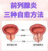 前列腺炎三种自愈方法