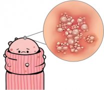 小弟外皮上面溃疡怎么治疗