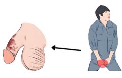 男性生殖外皮溃烂怎么治