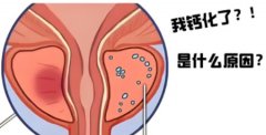 前列腺钙化灶是怎么回事,严重吗