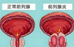 前列腺炎要禁欲多久才可以恢复