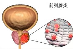 前列腺炎最快恢复方法