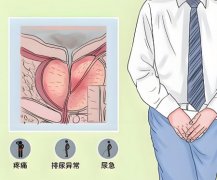 怎样判断有前列腺炎
