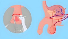 25岁了割包茎还有用吗