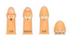 包皮过长图片及解析